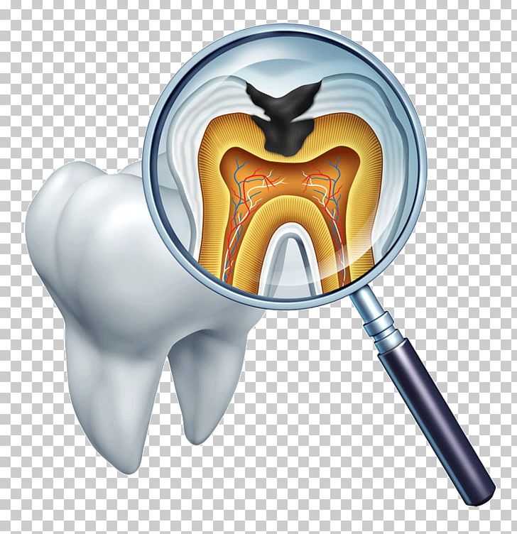 Tooth Decay Dentistry Dental Restoration Dental Public Health PNG, Clipart, Cavity, Closeup, Decay, Dental Anatomy, Dental Plaque Free PNG Download