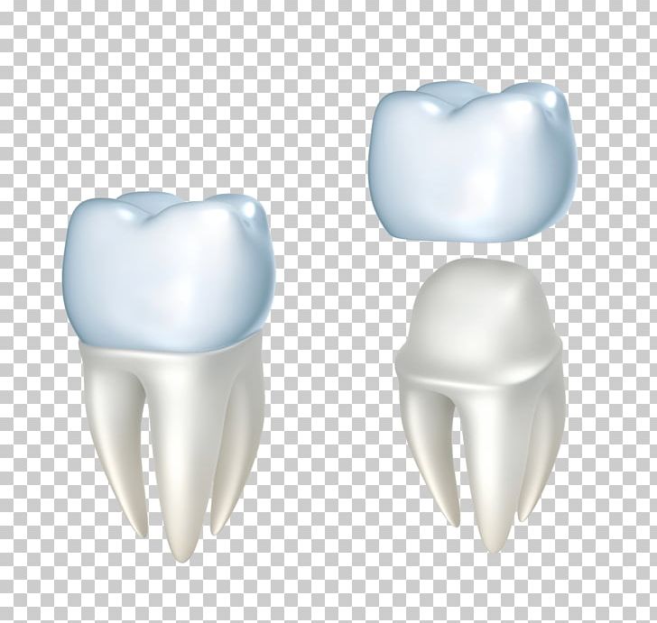 Crown Dentistry Dental Restoration Bridge PNG, Clipart, Bridge, Cosmetic Dentistry, Crown, Dental Floss, Dental Implant Free PNG Download