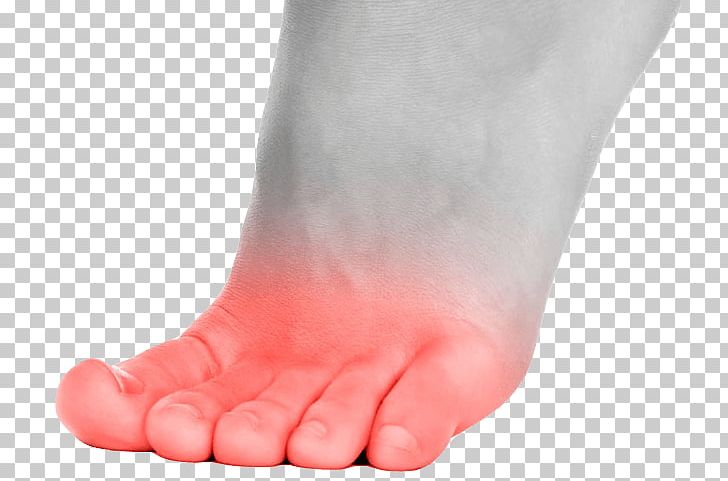 Toe Foot Ball Callus Disease PNG, Clipart,  Free PNG Download