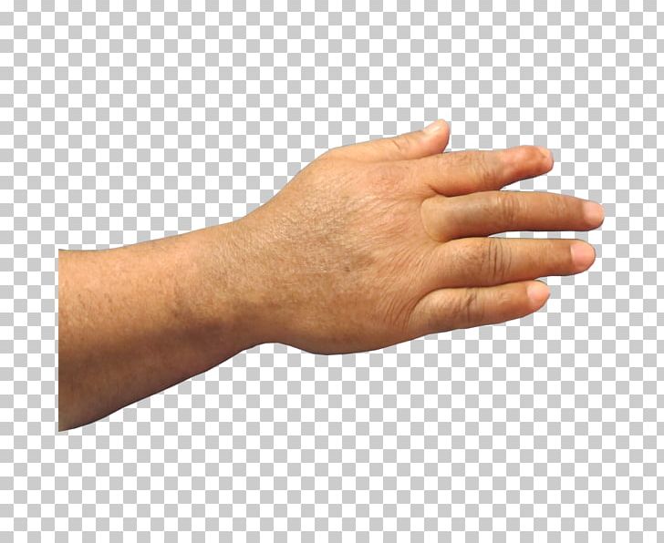 Thumb Prosthesis Hand Amputation Finger PNG, Clipart, Aesthetics, Amputation, Arm, Disability, Finger Free PNG Download