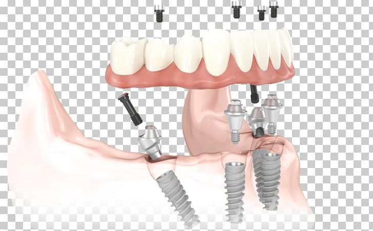 All-on-4 Dental Implant Dentistry Dentures PNG, Clipart, Allon4, Bridge, Dental Implant, Dental Surgery, Dentist Free PNG Download