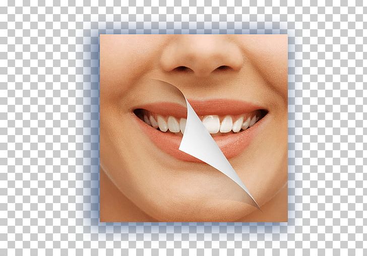 Tooth Whitening Cosmetic Dentistry Oral Hygiene PNG, Clipart, Cheek, Chin, Closeup, Cosmetic Dentistry, Dental Composite Free PNG Download