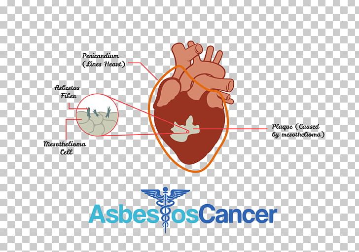 Mesothelioma Cancer Asbestos-related Diseases Chemotherapy PNG, Clipart, Asbestos, Asbestosrelated Diseases, Blood, Blood Test, Brand Free PNG Download