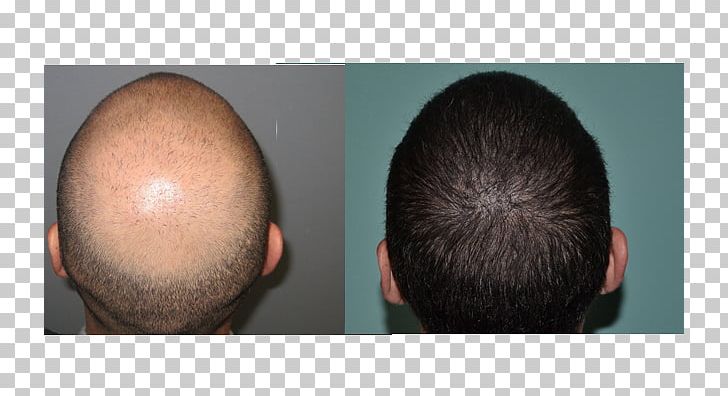 Hair Transplantation Follicular Unit Extraction Follicular Unit Transplantation Hair Loss Organ Transplantation PNG, Clipart, Chin, Ear, Facial Hair, Follicular Unit Extraction, Follicular Unit Transplantation Free PNG Download