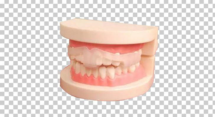 Tooth Dental Braces Cosmetic Dentistry PNG, Clipart, Braces, Celebrities, Chin, Crown, Dental Braces Free PNG Download