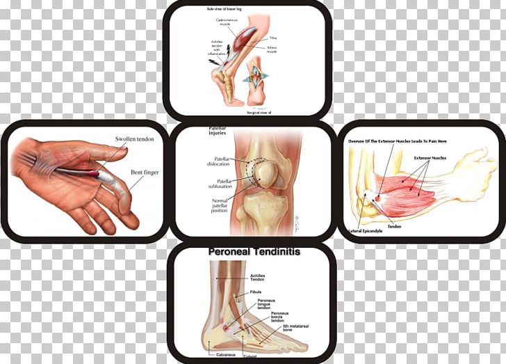 Tendon Type I Collagen Tendinopathy Finger PNG, Clipart, Chondroitin Sulfate, Collagen, Fibril, Finger, Hand Free PNG Download
