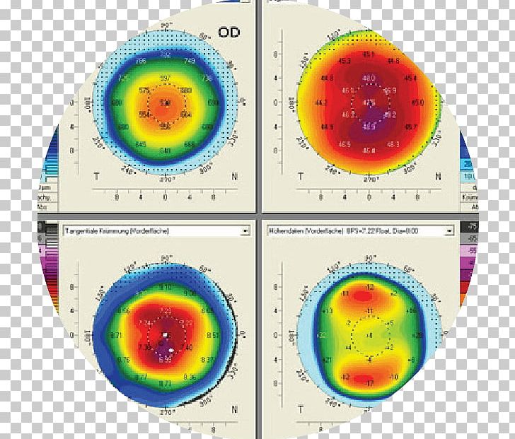 Cataract Corneal Topography Eye Examination PNG, Clipart, Area, Autorefractor, Cataract, Cataract Surgery, Circle Free PNG Download