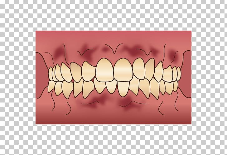 Tooth 審美歯科 Dentist Gums PNG, Clipart, Dental Braces, Dental Surgery, Dentist, Eyelash, Gums Free PNG Download