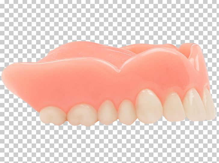 Dentures Tooth Dentistry Gums Removable Partial Denture PNG, Clipart, Aspen, Aspen Dental, Basic, Dental, Dental Abscess Free PNG Download