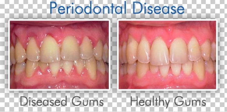 Swollen Gums Gingivitis Periodontal Disease Dentistry PNG, Clipart, Bleeding On Probing, Cosmetic Dentistry, Dental Extraction, Dental Floss, Dentistry Free PNG Download