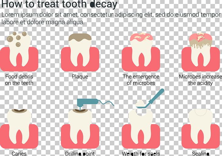 Tooth Decay Dentistry Euclidean PNG, Clipart, Dental Plaque, Design, Happy Birthday Vector Images, Individual, Infographic Free PNG Download