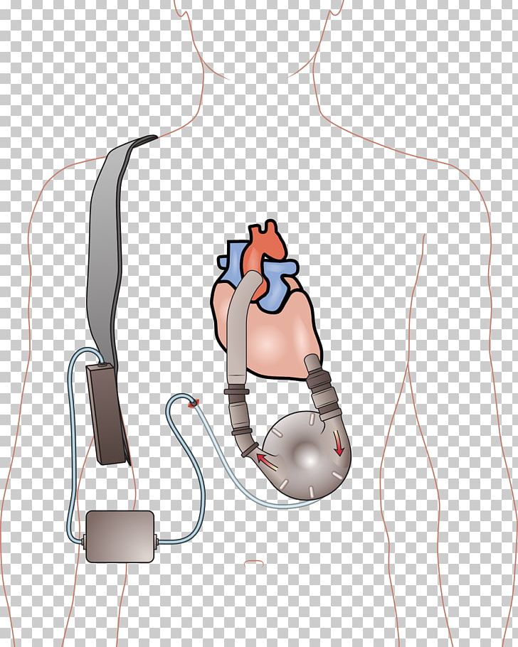 Ventricular Assist Device Artificial Heart Ventricle Heart Failure PNG, Clipart, Abdomen, Active Undergarment, Angle, Aorta, Arm Free PNG Download