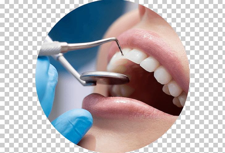 Cosmetic Dentistry Dental Surgery Oral Hygiene PNG, Clipart, Chin, Cosmetic Dentistry, Dental Hygienist, Dental Implant, Dental Implants Free PNG Download