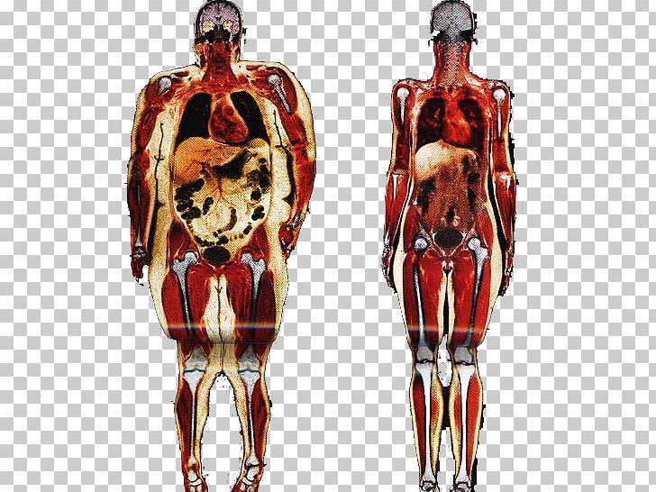 Obesity Human Body Adipose Tissue Anatomy Connective Tissue PNG, Clipart, Adipose Tissue, Anatomy, Body Composition, Bone, Cardiovascular Disease Free PNG Download
