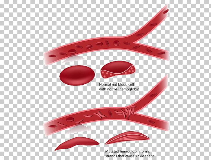 Sickle Cell Disease Red Blood Cell Anemia PNG, Clipart, Anemia, Blood, Blood Cell, Cancer, Cell Free PNG Download