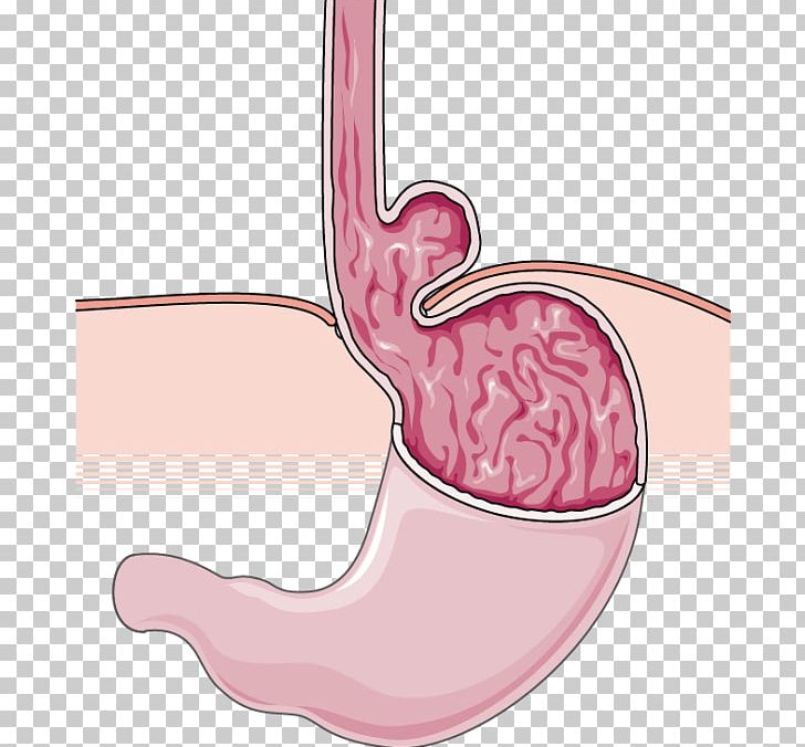Hiatal Hernia Esophagus Stomach Esophageal Cancer Gastroesophageal Reflux Disease PNG, Clipart, Abdomen, Abdominal Cavity, Cancer, Cardia, Disease Free PNG Download