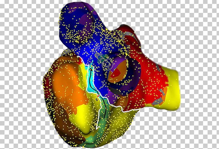 St. Jude Medical Cardiology Heart Arrhythmia Catheter PNG, Clipart, Ablation, Accuracy And Precision, Atrial Fibrillation, Cardiology, Catheter Free PNG Download