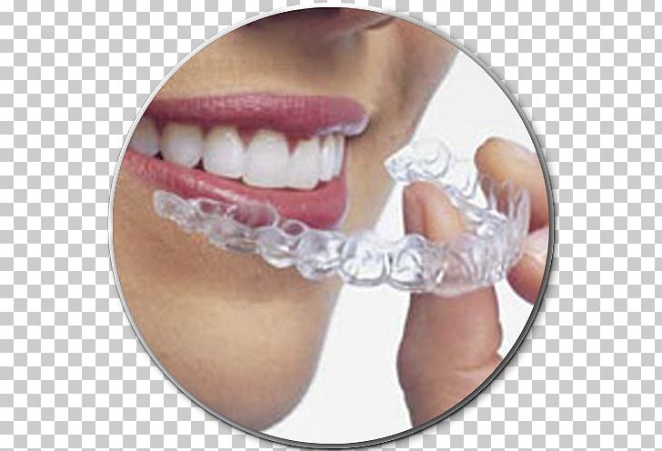 Clear Aligners Dental Braces Orthodontics Dentistry Therapy PNG, Clipart, Clear Aligners, Cosmetic Dentistry, Dental Braces, Dental Surgery, Dentist Free PNG Download
