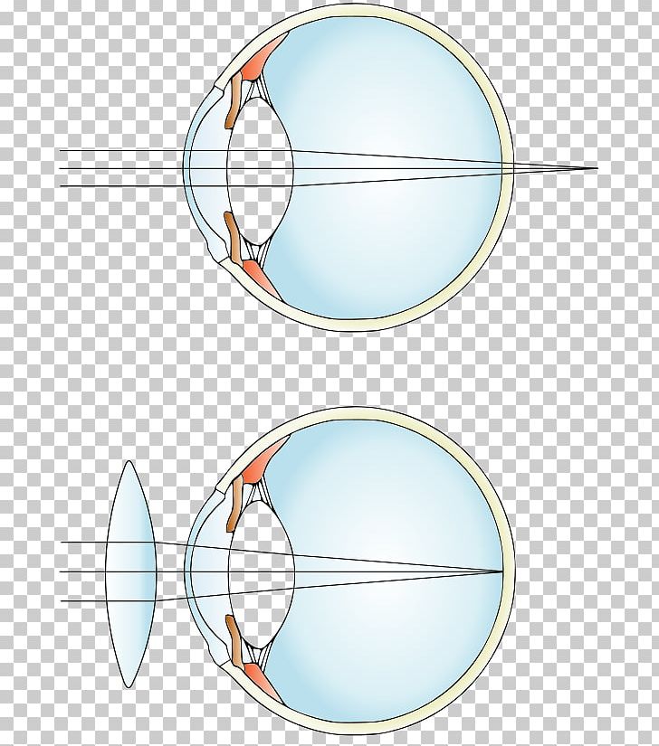 Hypermetropia Near-sightedness Lens Eye Glasses PNG, Clipart, Angle, Area, Circle, Contact Lenses, Eye Free PNG Download