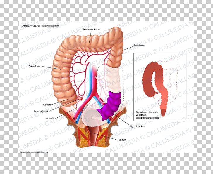 Colorectal Cancer Surgery Colon PNG, Clipart, Cancer, Cancer Screening, Chemotherapy, Colon, Colorectal Cancer Free PNG Download