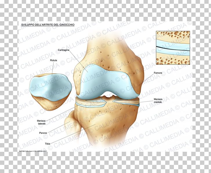 Knee Osteoarthritis Anatomy Bone Fracture PNG, Clipart, Anatomy, Arthritis, Bone Fracture, Ear, Finger Free PNG Download