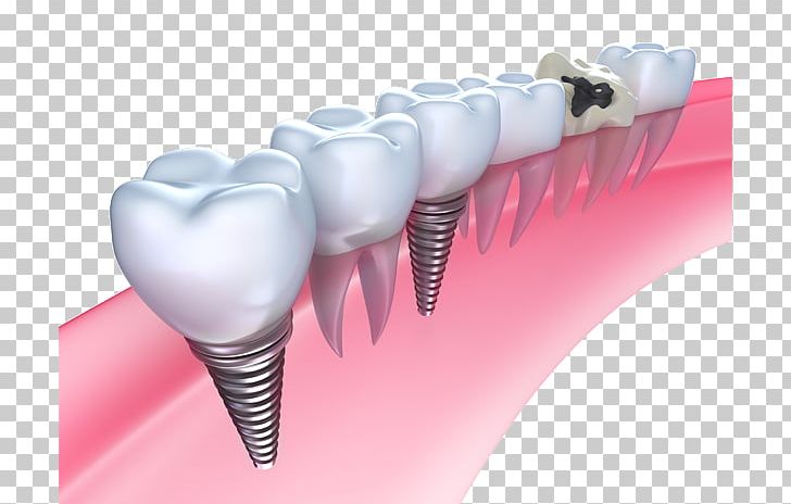 Dental Implant Dentistry Bridge PNG, Clipart, Bone Grafting, Bridge, Brush, Dental Implant, Dental Restoration Free PNG Download