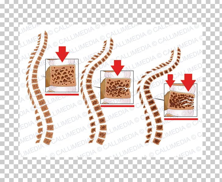 Osteoporosis Bone Fracture Vertebral Column Vertebral Compression Fracture PNG, Clipart,  Free PNG Download
