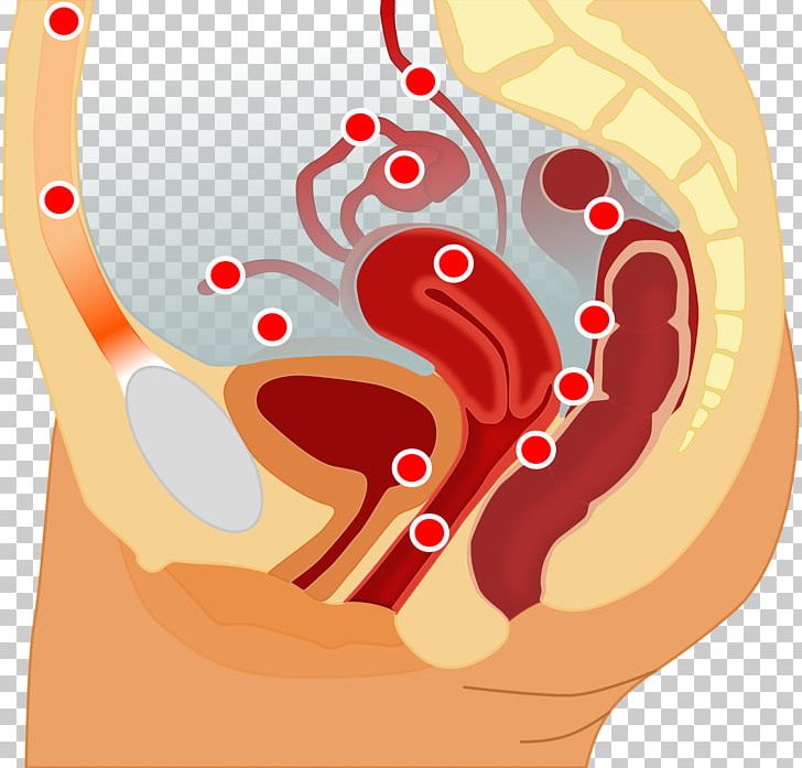 Endometriosis Endometrium Pelvic Pain Uterus Disease PNG, Clipart, Adenomyosis, Art, Ear, Heart, Human Body Free PNG Download