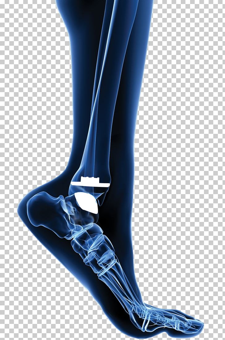 Total Ankle Arthroplasty Ankle Replacement Joint Replacement PNG, Clipart, Ankle, Ankle Replacement, Arthritis, Arthroplasty, Calf Free PNG Download