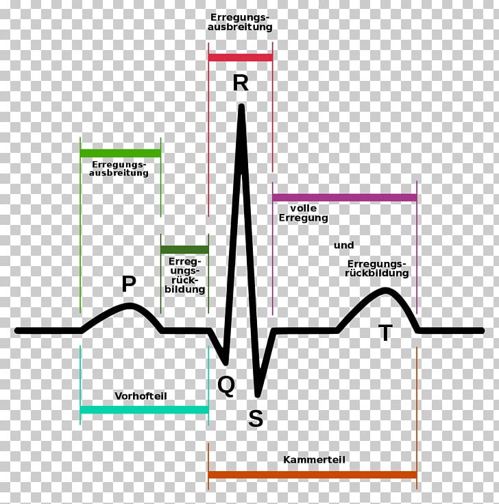 Electrocardiography Heart Arrhythmia Signal Processing Atrial Fibrillation PNG, Clipart, 3lead Ekg, Angle, Area, Atrial Fibrillation, Atrium Free PNG Download