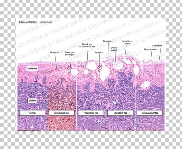 Histology Keratinocyte Dermatitis Corte Histológico Acanthosis PNG, Clipart, Anatomy, Angle, Biology, Brand, Cell Free PNG Download