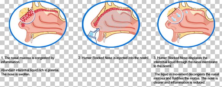 Nasal Congestion Nose Mucous Membrane Rhinitis Inflammation PNG, Clipart, Allergy, Area, Blood Vessel, Brain, Hay Fever Free PNG Download
