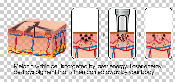 Tattoo Removal Nd:YAG Laser Détatouage Laser PNG, Clipart, Brand, Complexion, Freckle, Gift, Hair Removal Free PNG Download