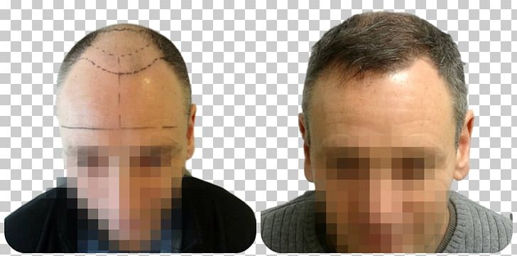 Hair Transplantation Follicular Unit Extraction Forehead Eyebrow PNG, Clipart, Cheek, Chin, Ear, Eyebrow, Face Free PNG Download