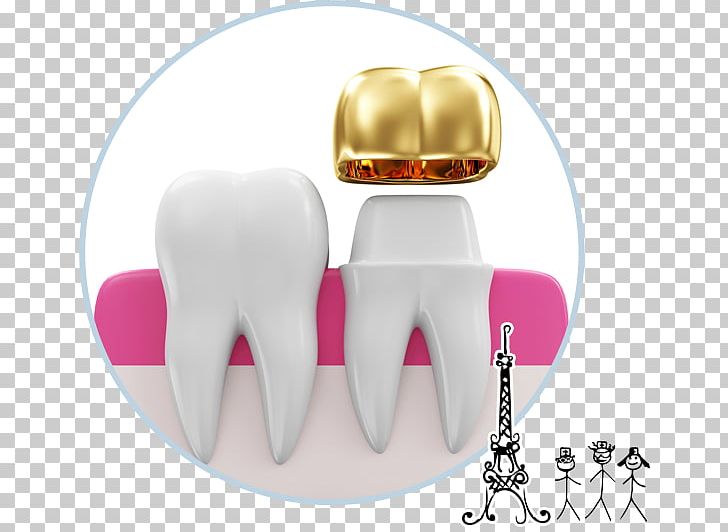 Tooth Crown Dentistry Prosthodontics Dental Implant PNG, Clipart, Body Jewelry, Bridge, Crown, Dental, Dental Implant Free PNG Download