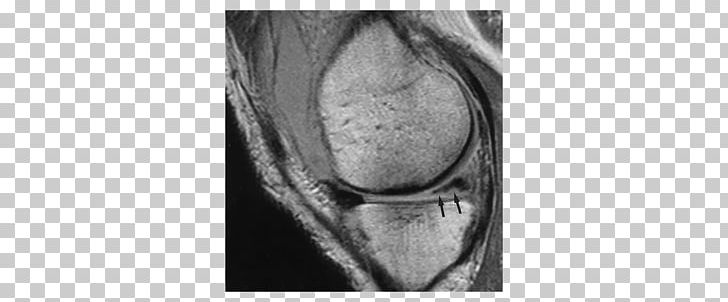 Knee Meniscus Magnetic Resonance Imaging Ligament X-ray PNG, Clipart, Arm, Black And White, Bone, Drawing, Figure Drawing Free PNG Download