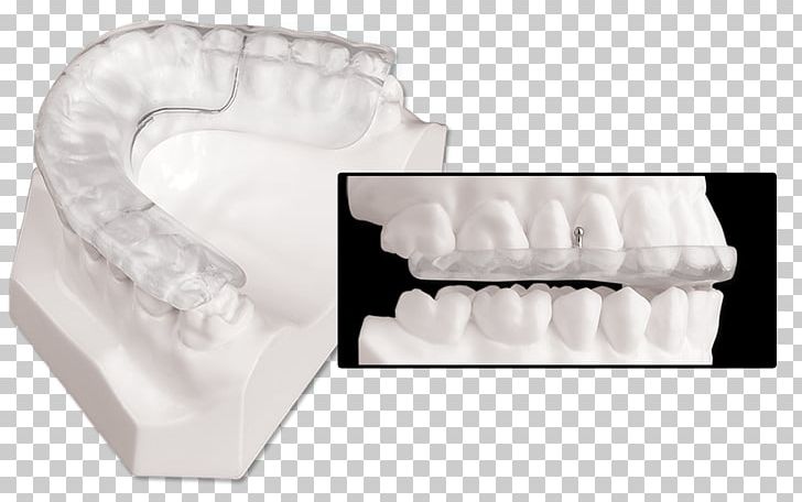 Splint DynaFlex Maxilla Jaw PNG, Clipart, 45 Years, Dynaflex, Home Appliance, Jaw, Maxilla Free PNG Download