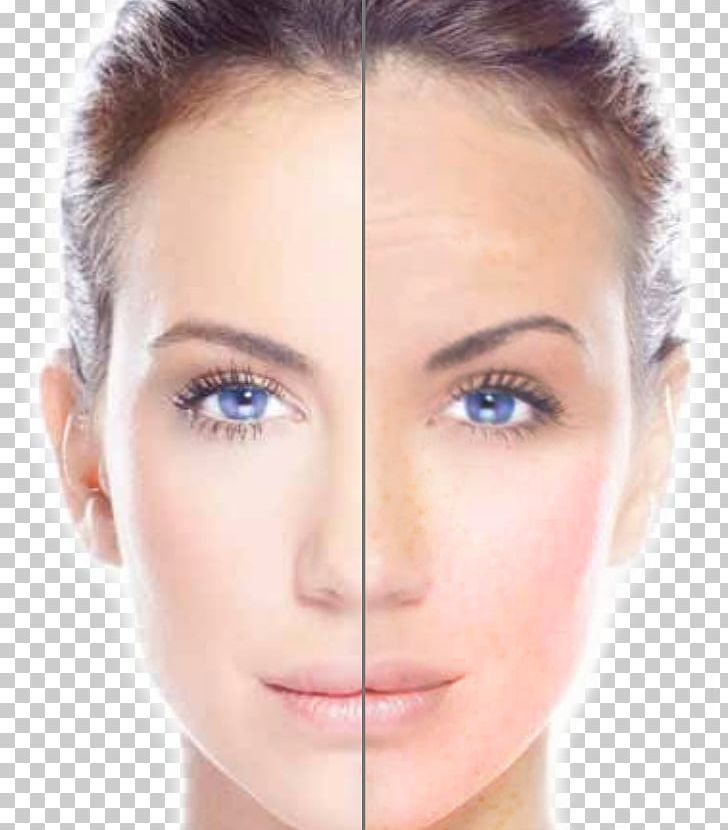 Radio Frequency Skin Tightening Skin Care Photorejuvenation Chemical Peel PNG, Clipart, Acne, Beauty, Center For Facial Rejuvenation, Cheek, Chemical Peel Free PNG Download