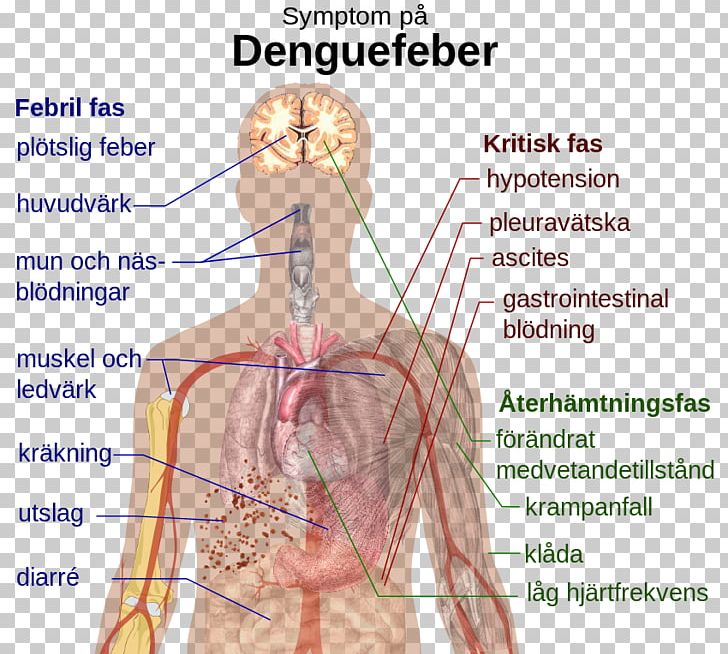 Dengue Virus Symptom Viral Hemorrhagic Fever PNG, Clipart, Abdomen, Angle, Arm, Dengue Fever, Disease Free PNG Download