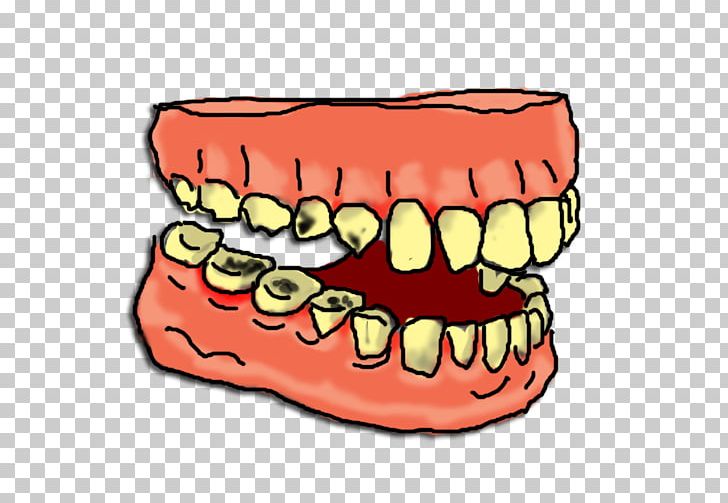 Tooth Decay Tooth Pathology PNG, Clipart, Chickie Cliparts, Computer, Dentist, Dentistry, Free Content Free PNG Download