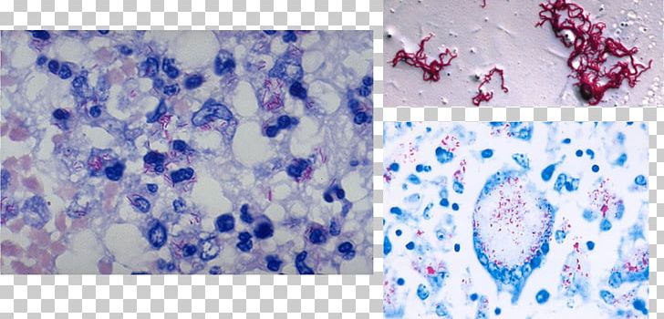 Miliary Tuberculosis Acid-fastness Ziehl–Neelsen Stain Gram Stain PNG, Clipart, Acidfastness, Bacteria, Blue, Bone Marrow, Disease Free PNG Download