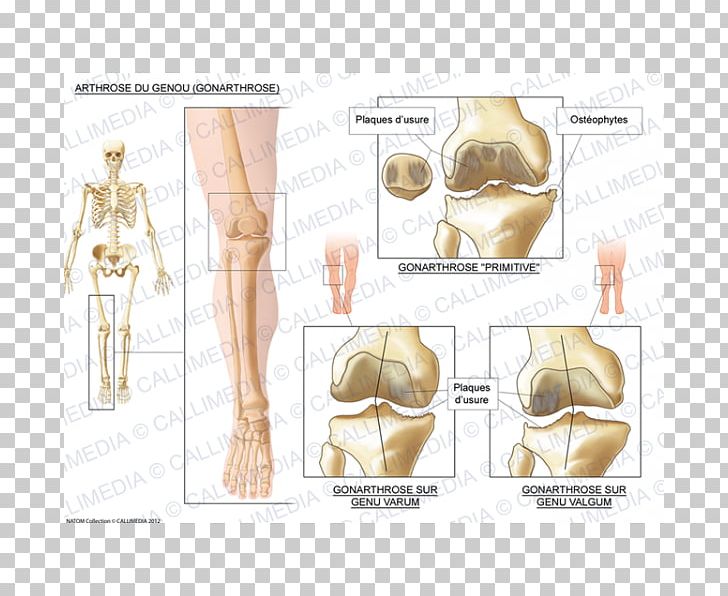 Knee Osteoarthritis Knee Osteoarthritis Knee Arthritis PNG, Clipart, Abdomen, Arm, Arthritis, Bone, Chest Free PNG Download