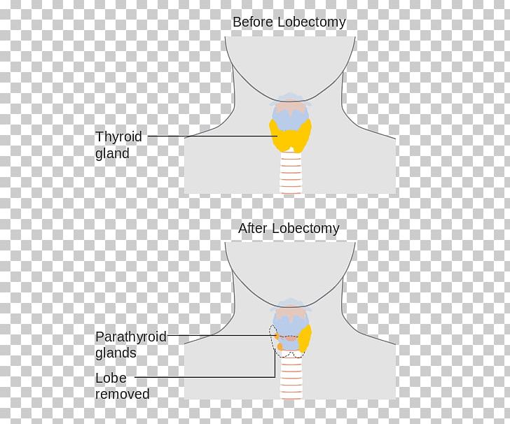 Thyroidectomy Lobectomy Surgery Thyroid Cancer PNG, Clipart, Anatomy, Angle, Brand, Diagram, Gland Free PNG Download