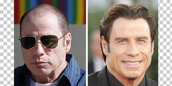 John Travolta John Cleese Hair Transplantation Hair Loss Celebrity PNG, Clipart, Actor, Celebrity, Chin, Cosmetics, Elton John Free PNG Download