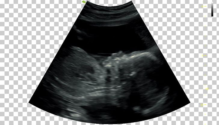 Ultrasound Technology 4D Film Infant Black M PNG, Clipart, 4d Film, Black, Black M, Infant, Others Free PNG Download