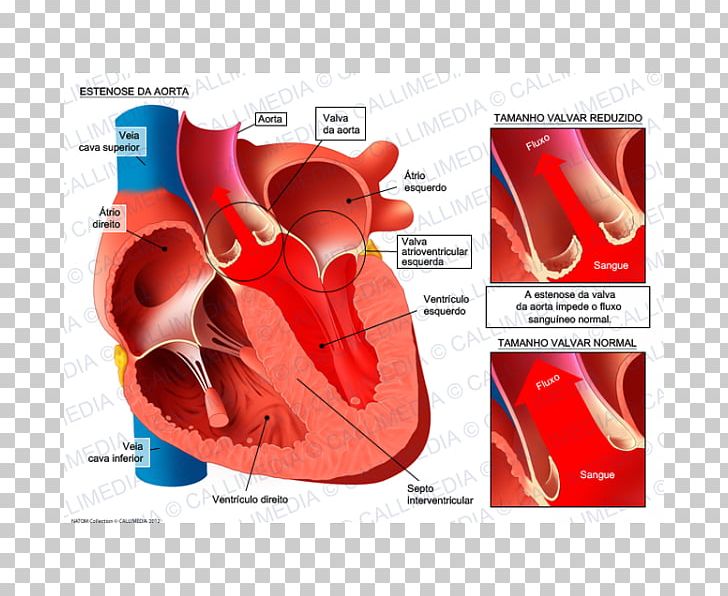 Mitral Valve Stenosis Mitral Insufficiency Aorta Aortic Insufficiency PNG, Clipart, Abdominal Aorta, Aorta, Aortic Insufficiency, Aortic Stenosis, Aortic Valve Free PNG Download