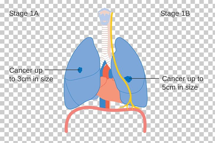 Lung Cancer Staging PNG, Clipart, Angle, Cancer, Cancer Research Uk, Cancer Staging, Diagram Free PNG Download