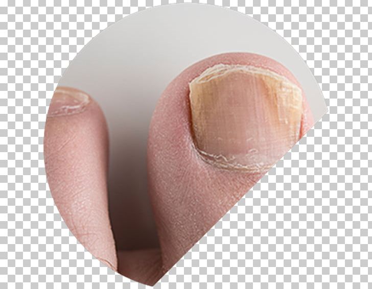 Onychomycosis The Nail Fungal Nail Infection PNG, Clipart,  Free PNG Download