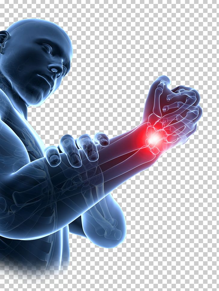Repetitive Strain Injury Carpal Tunnel Syndrome Wrist Carpal Bones PNG, Clipart, Carpal Bones, Carpal Tunnel, Carpal Tunnel Syndrome, Computer Wallpaper, Hand Free PNG Download
