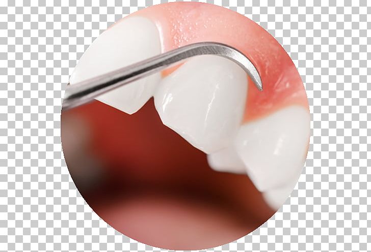 Gums Periodontal Disease Gingival Graft Swelling Gingivitis PNG, Clipart, Chisinau, Dent, Dental, Dentist, Dentistry Free PNG Download